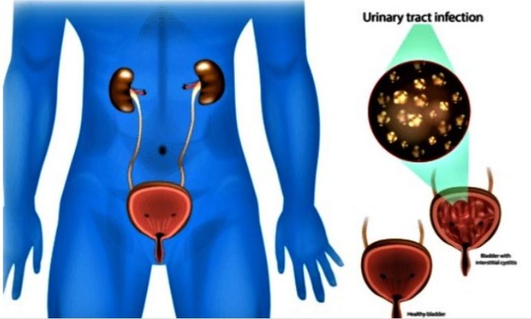 Why More Older Men Are Suffering From Urinary Tract Infections – Expert Reveals